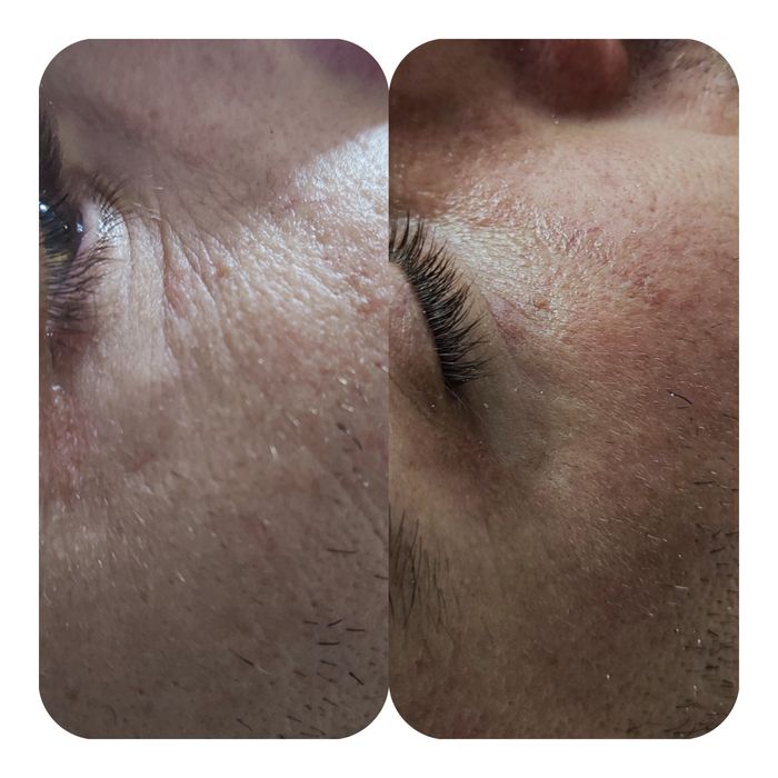 Limpeza de pele profunda