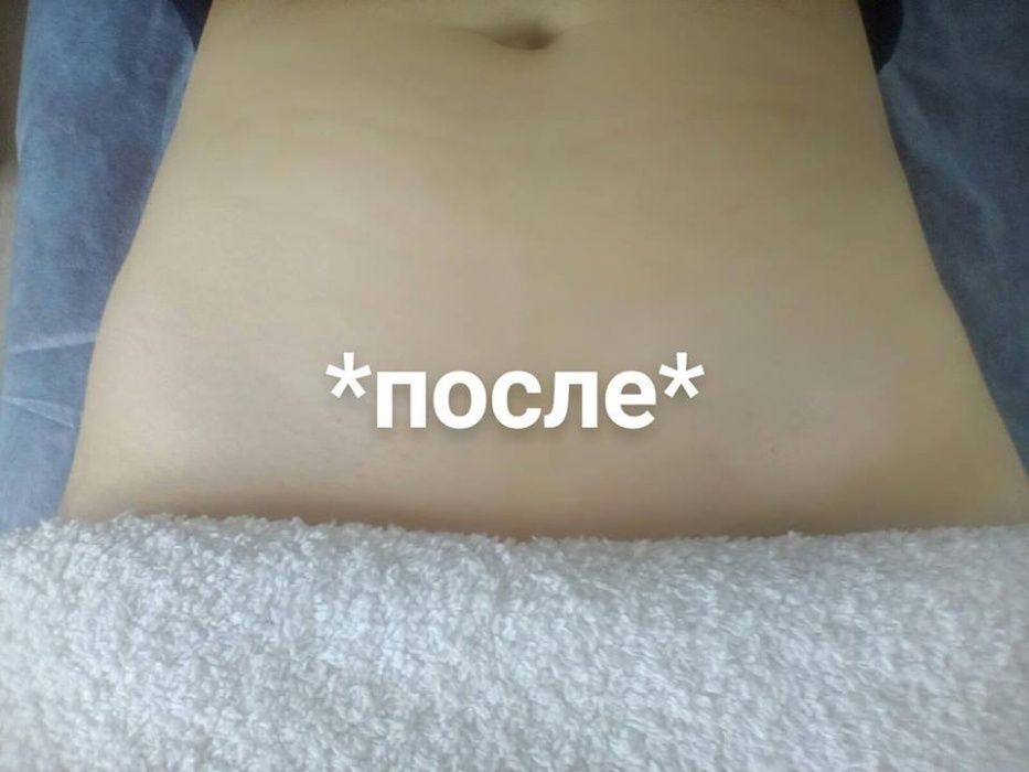 Шугаринг (сахарна депіляція)