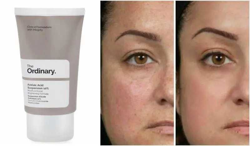 The Ordinary - Легка емульсія з азелаїновою кислотою 10% - 30ml
