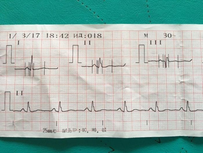 Кардиограмма на дому