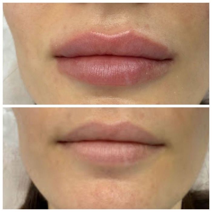 Ботокс| Збільшення губ