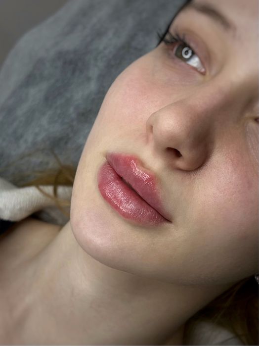 Увеличение губ от 2000! косметолог, ботокс био- мезо- Черкассы