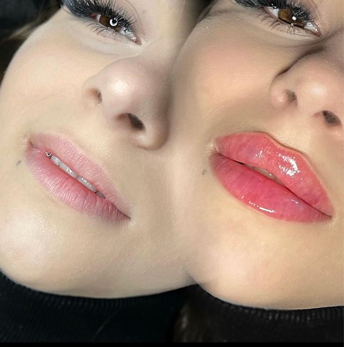 Увеличение губ, 1500 грн, топ техника!