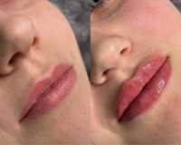 Косметолог.Увеличение губ  ,Чистка лица,Мезотерапия ,Плазмолифтинг.