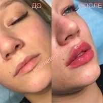 Увеличение губ от 2100 грн Sardenya Deep 1 ml