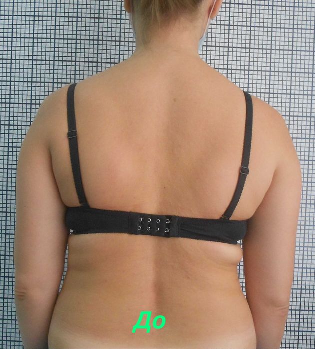 Лікування міжхребцевої грижі