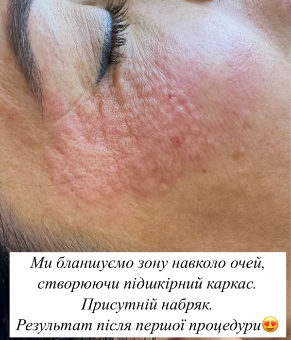 Акція на всю контурну пластику обличчя. Збільшення губ, ботокс, біо