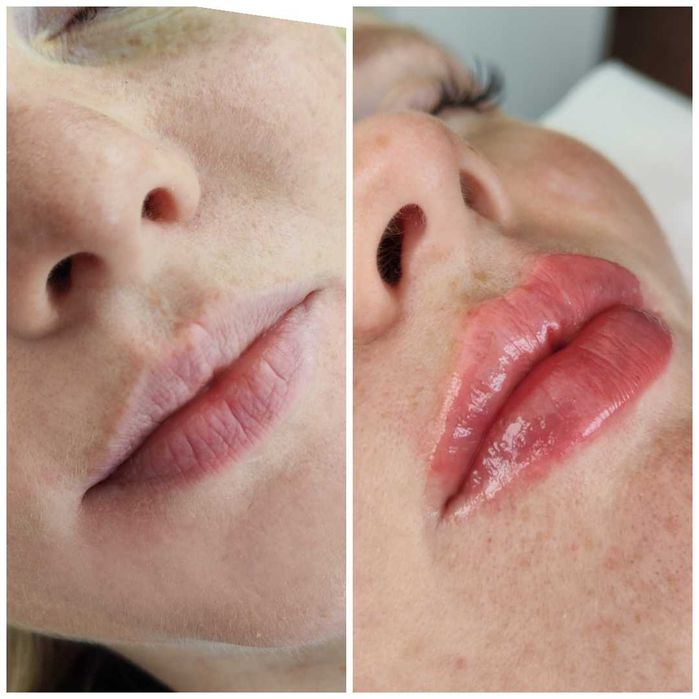 Увеличение губ, контурная коррекция