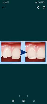 Полимерные гранулы для восстановления зубов  5г, 10г, 20г