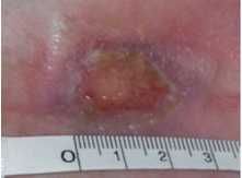 Máquina de Laser Kolina 5a Geração para Acupuntura, Fisioterapia