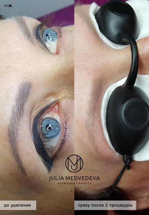 Видалення неякісного татуажу та тату Харків