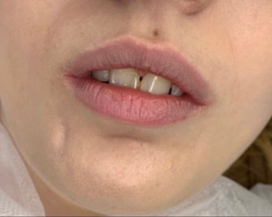 Увеличение губ, ботокс