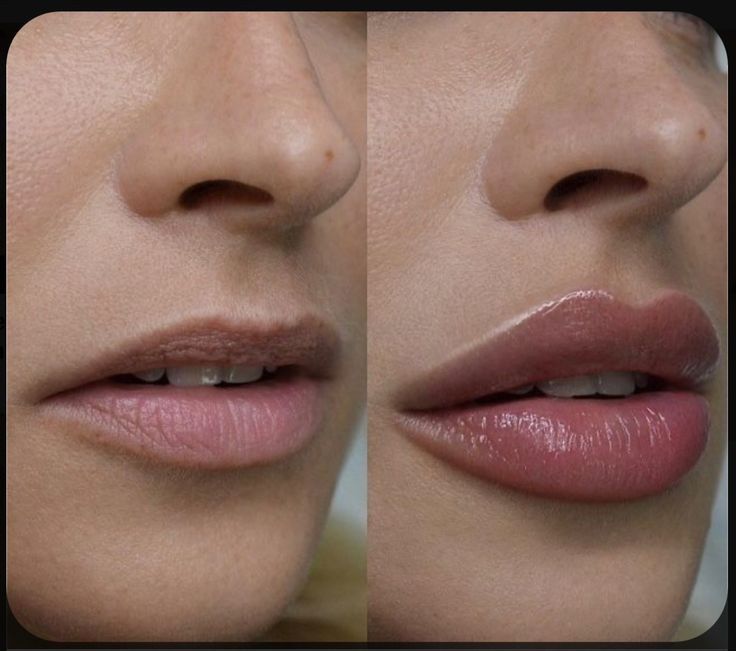 Моделювання губ гіалуронкою, об'м губ, контурна пластика губ уколи губ