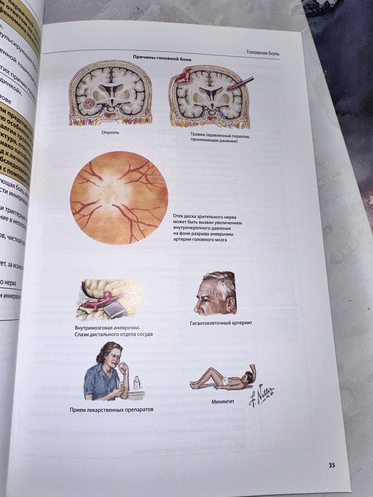 Диагностика и лечение боли (Неттер) справочник по неврологии