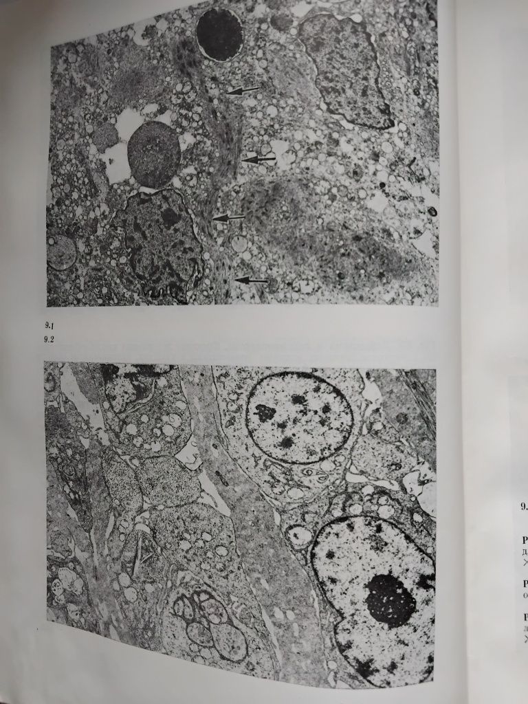 Электронная микроскопия опухолей мягких тканей.А.С.Ягубов.В.А.Кац.1984