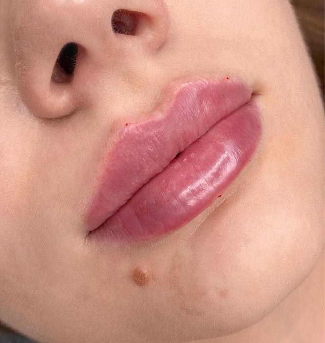 Косметолог. Увеличения Губ. Углы Джоли , скулы , Подбородок. Ботокс .