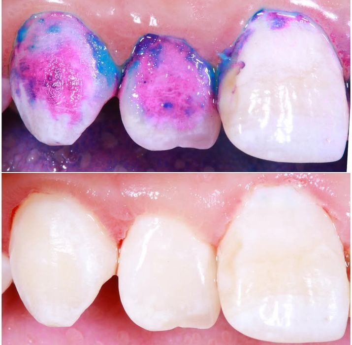 Професійна чистка зубів / Зняття зубного каменю / AirFlow — недорого