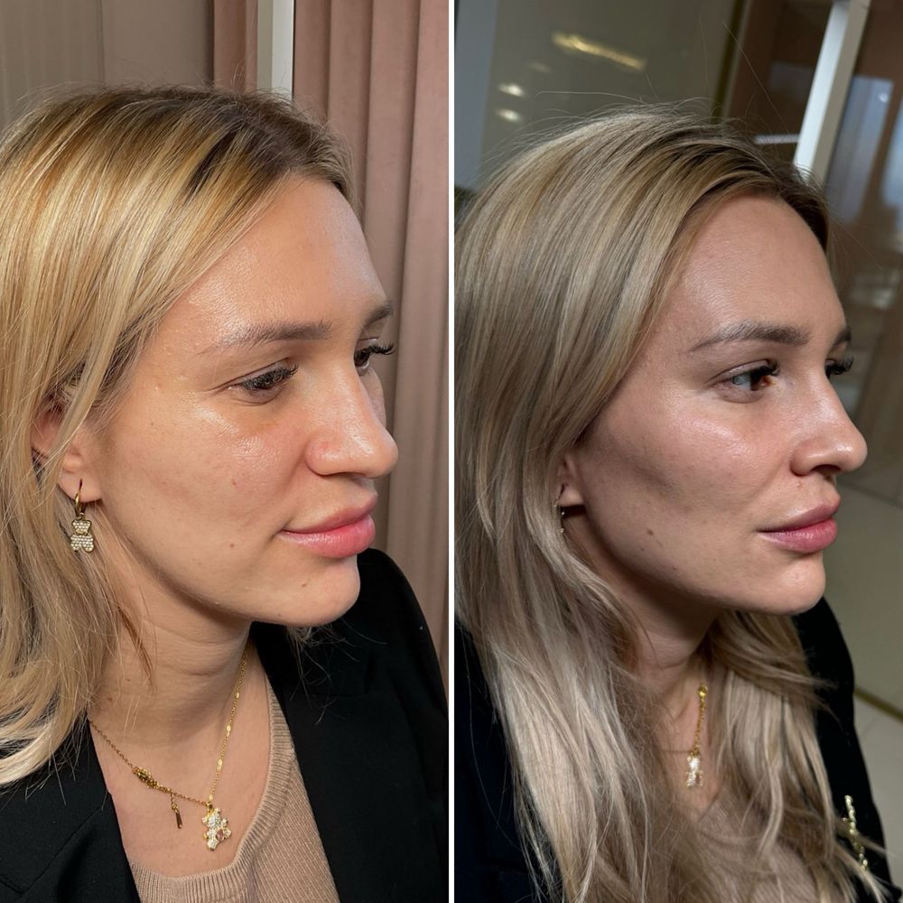 Medycyna estetyczna Modelowanie ust Wolumetria Botoks Stymulatory