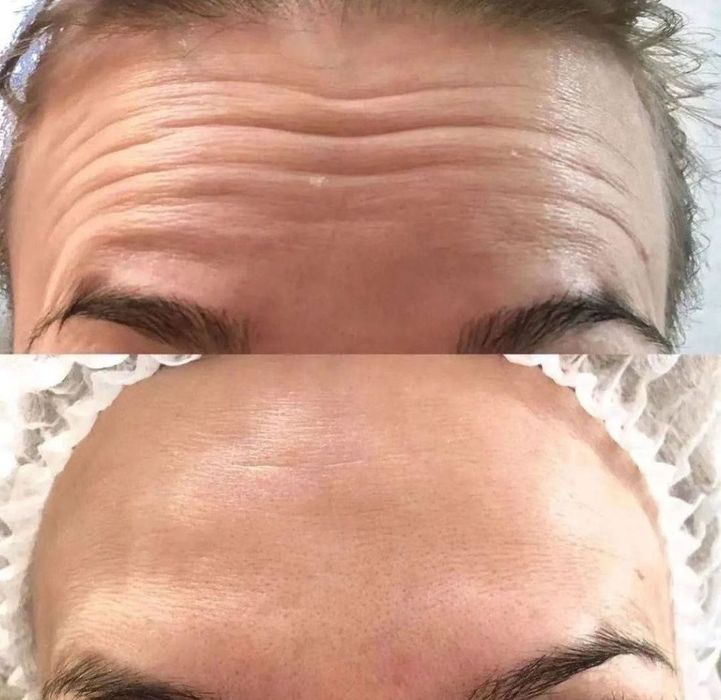 Ботокс, мезонити, увеличение губ,ягодиц