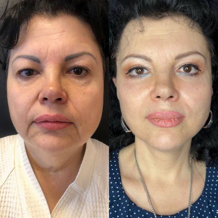 Косметолог Николаев ,губы 3500,ботокс биоревитализация