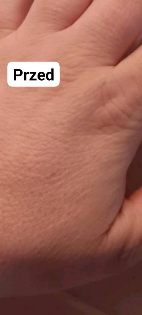 Skin Renew. Mikrodermabrazja i enzymy. Peeling twarzy
