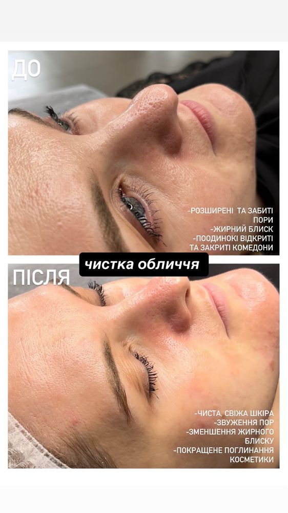 КОСМЕТОЛОГ ЛЬВІВ | МАСАЖ обличчя, чистка, пілінги