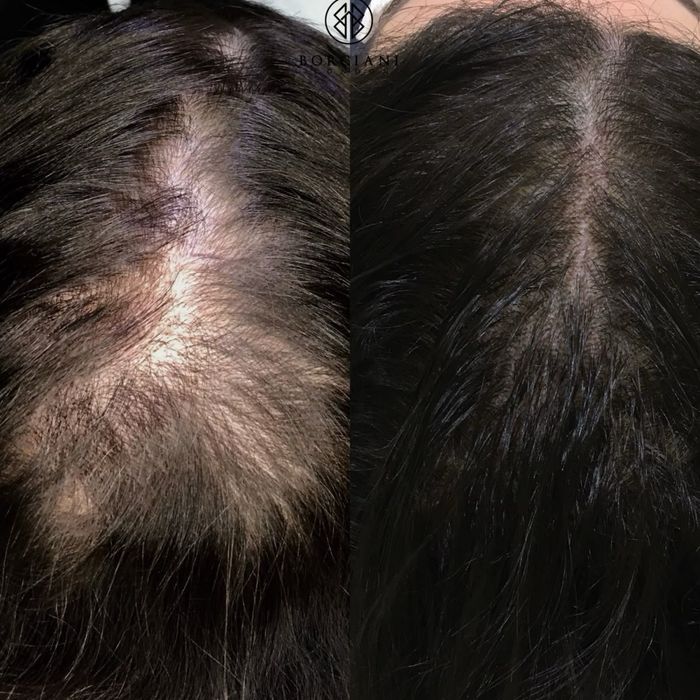 Трихолог, випадіння волосся, алопеція, пілінг шкіри голови, лупа