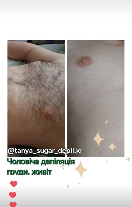 173 кв Шугаринг, депіляція жіноча, чоловіча