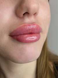 Увеличение губ от 1800! косметолог, ботокс био- мезо- Черкассы, центр
