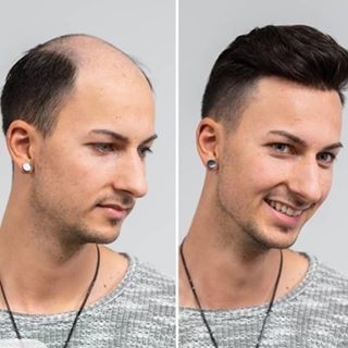 Prótese capilar em Alverca