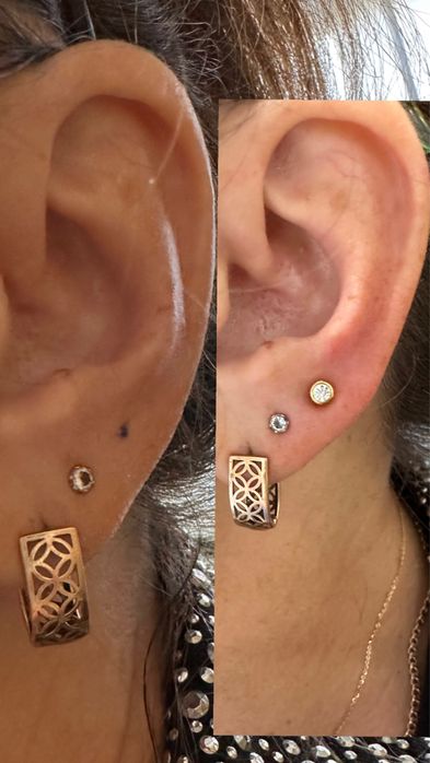 Електроепіляція, шугаринг,лазерна епіляція