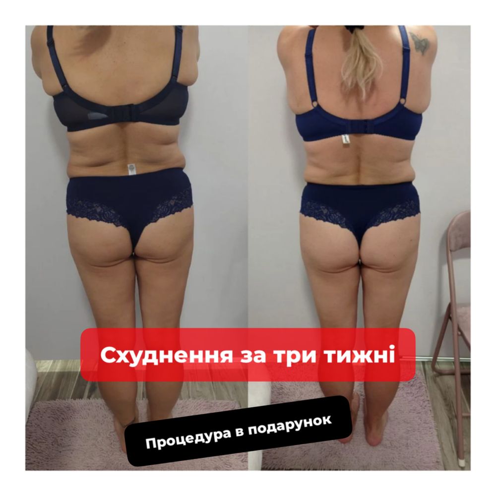 LPG масаж. До -10 см за курс!Пробна процедура  - 499 грн