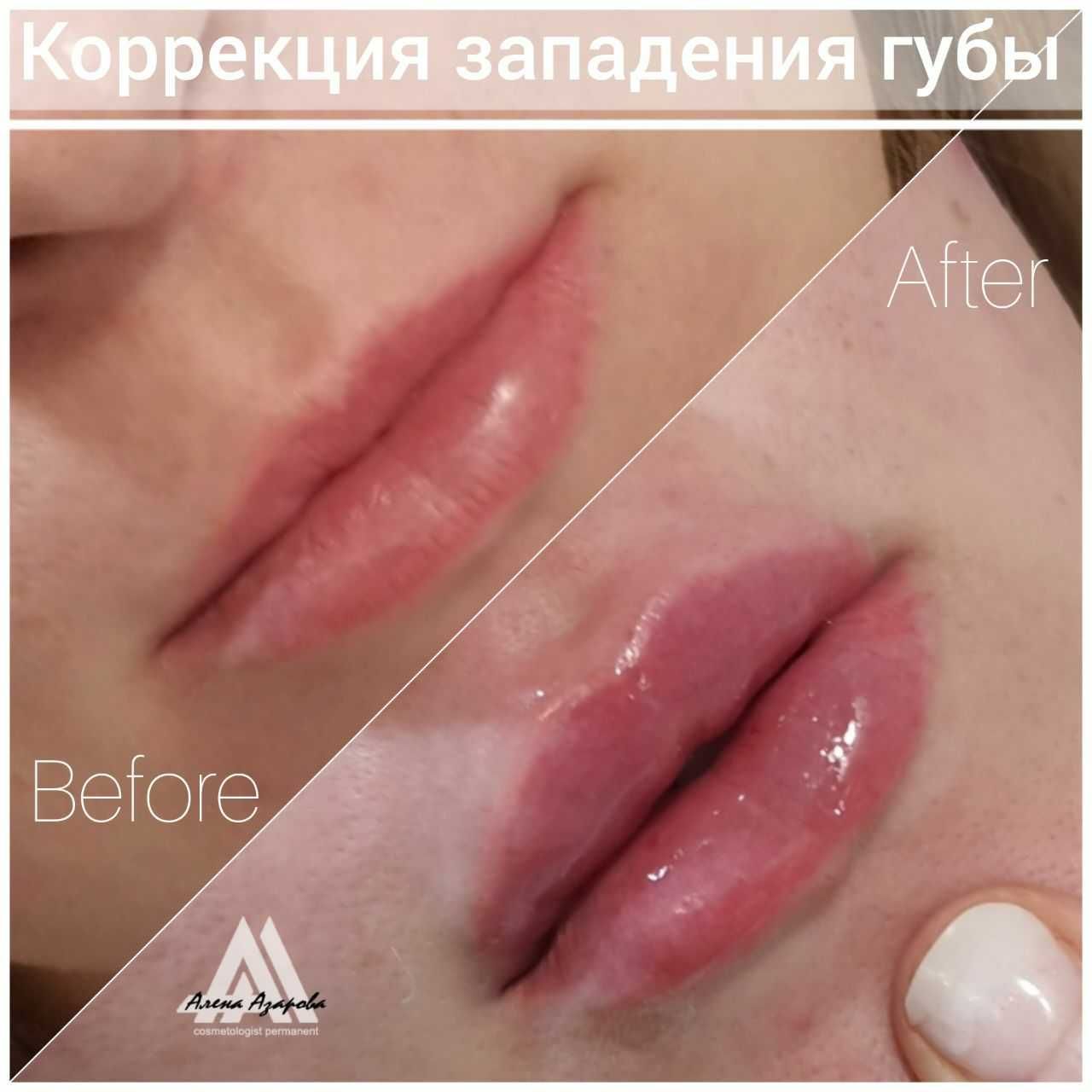 Косметолог. Контурная пластика, увеличение губ. Работаю р-н Госпрома.