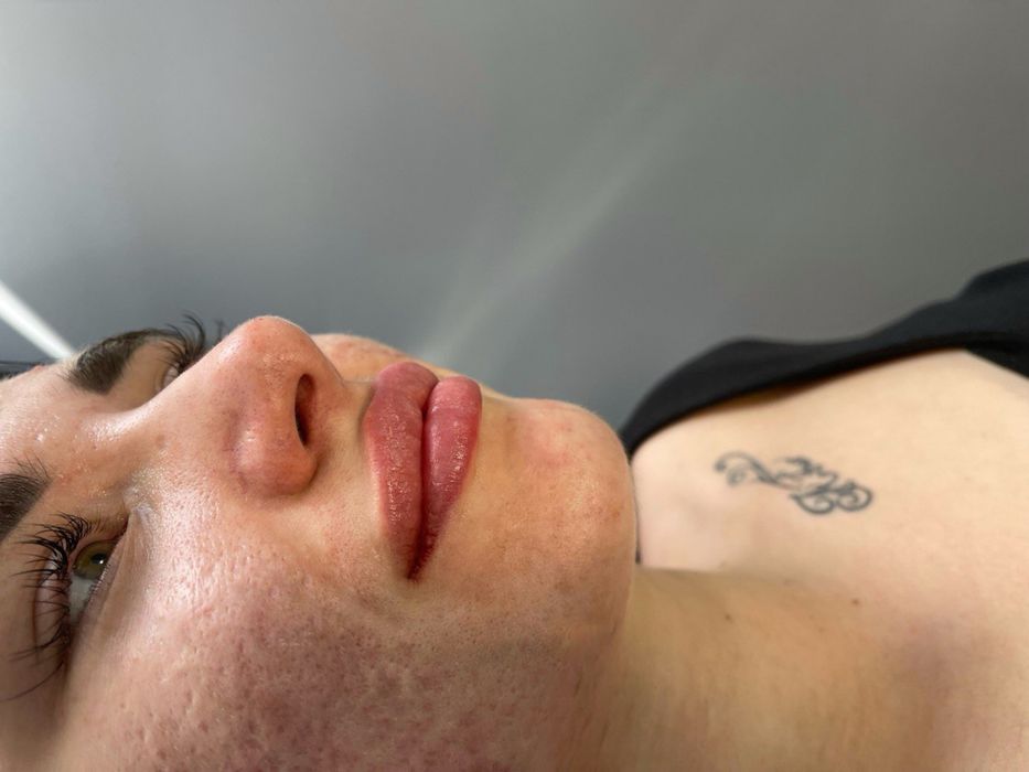 Контурна пластика губ від 3000 ботокс 1000