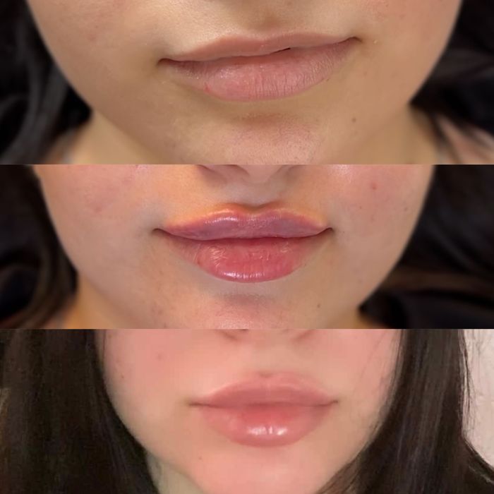 Модель на губы  ботокс Угли Джоли скули