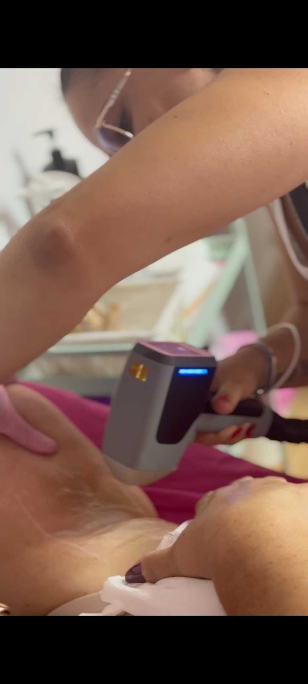depilação a laser