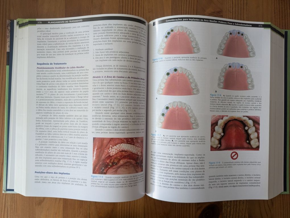 Livro Implantes Dentais Contemporâneos - Carl E. Misch - 3°edição