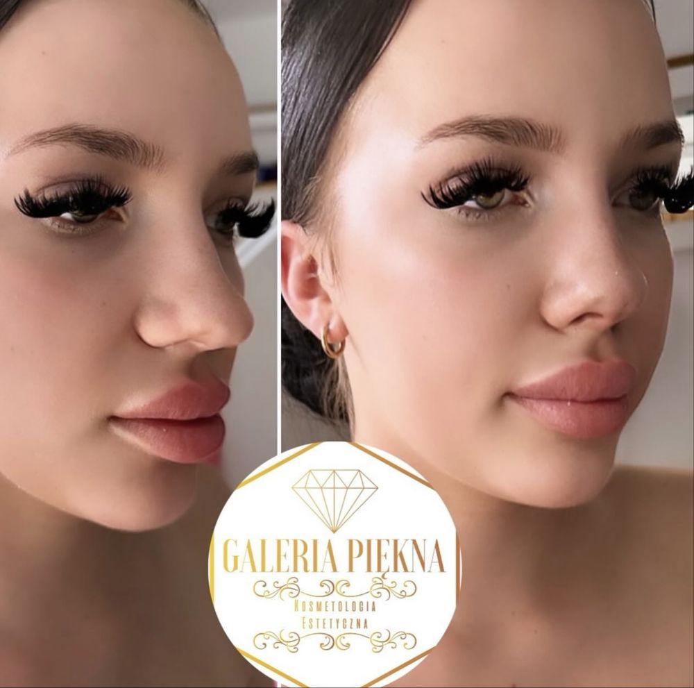Nici PDO COG Haczykowe 4d 6d 8d / lipoliza iniekcyjna / wolumetria