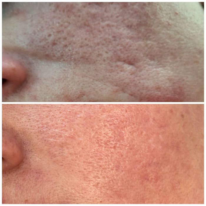 Холодна плазма НОВА розробка вчених Косметологічний апарат