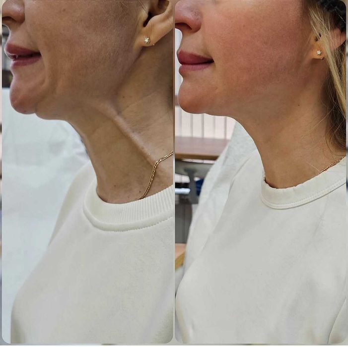 Лікар косметолог. БОТОКС . Ін'єкції краси.