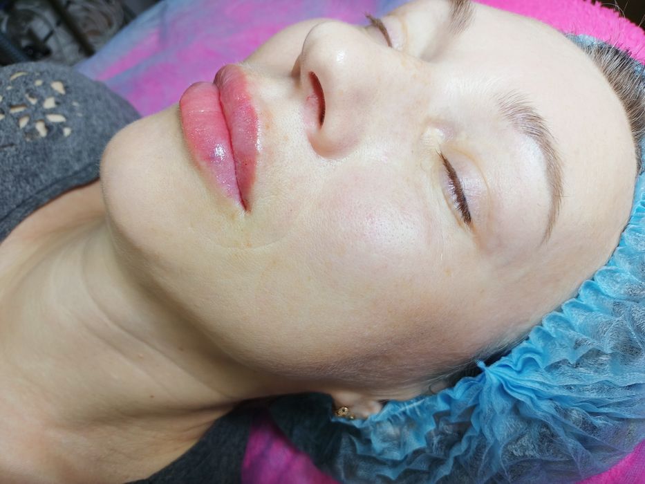 Косметолог, Біоревіталізація, Ботокс, Контурна пластика , мезотерапія.