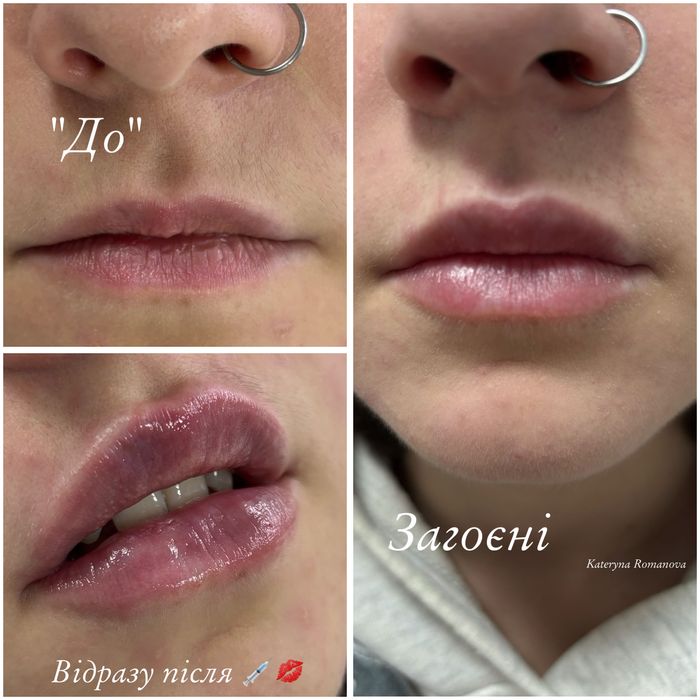 Безкоштовно збільшення губ / контурна пластика губ / ботокс