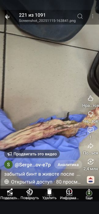 Нужно помощь!Киев.1год отказались достать бинт  который забыли в жывот