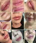 Powiększanie ust,stymulatory tkankowe,botox,Rzesy,lipoliza,dermapen,op