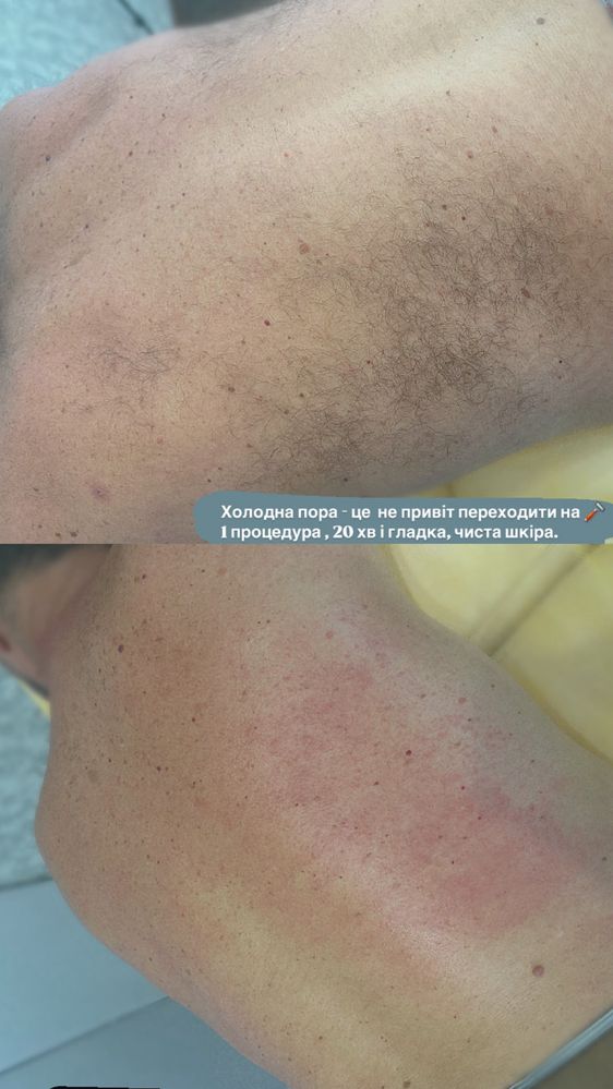 Чоловіча, жіноча депіляція, шугаринг, Миколаїв.