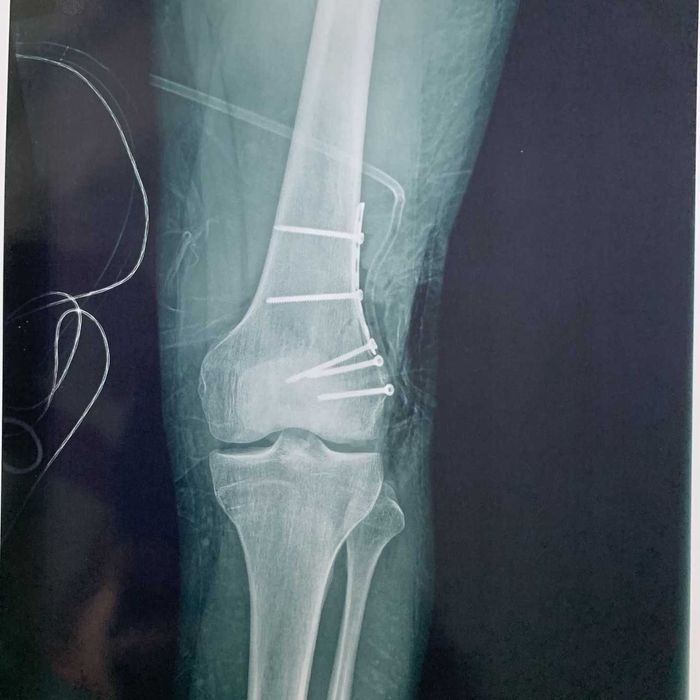 Титанова пластина та шурупи