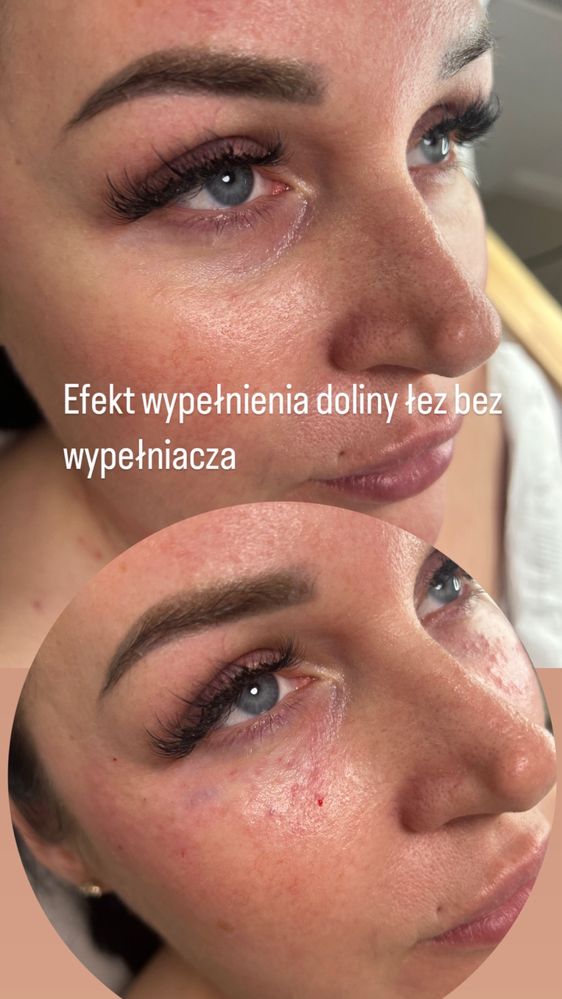 Powiększanie ust, botox , wolumetria, endermologia WARSZAWA 250 zł