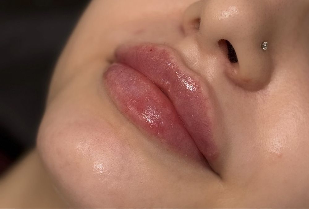 Modelowanie, powiększanie ust