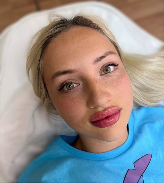 Ботокс.Увеличение губ.Гипергидроз