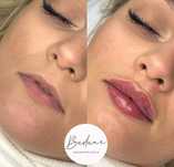 Powiększanie modelowanie ust lipoliza botoks botox kwas hialuronowy